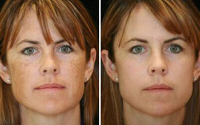 IPL & Laser Treatment Guide