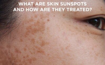 brown spots & the sun